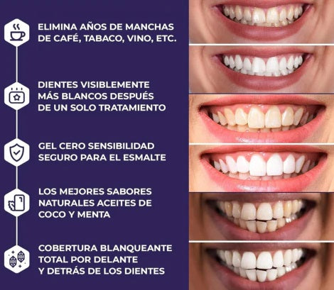 Bright Strips® - Kit profesional de blanqueamiento dental